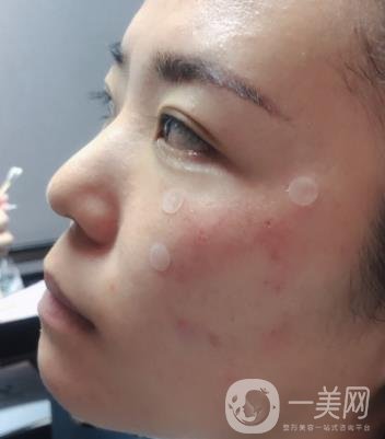 吉大一院整形美容科價格表費用明細，附祛斑案例