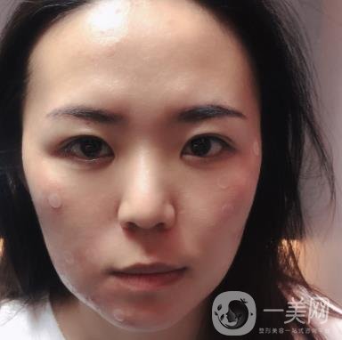 吉大一院整形美容科價格表費用明細，附祛斑案例