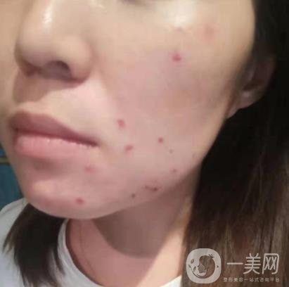 吉大一院整形美容科價格表費用明細，附祛斑案例