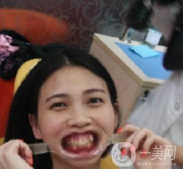 南昌大學(xué)第二附屬醫(yī)院整牙60天案例，還有價(jià)格表哦