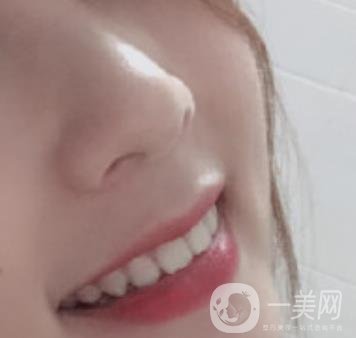 南昌大學(xué)第二附屬醫(yī)院整牙60天案例，還有價(jià)格表哦