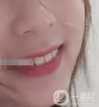 南昌大學(xué)第二附屬醫(yī)院整牙60天案例，還有價(jià)格表哦