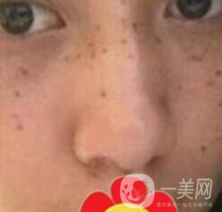 南方醫(yī)科大學(xué)南方醫(yī)院祛斑*果咋樣_案例_價(jià)格表