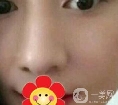 南方醫(yī)科大學(xué)南方醫(yī)院祛斑*果咋樣_案例_價(jià)格表