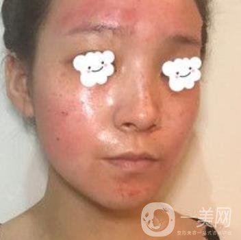 浙二醫(yī)院整形美容科價格表*新版，附激光祛斑*終*果圖