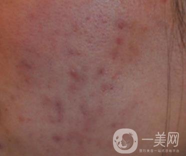 南通維多利亞美容醫(yī)院怎么樣?價(jià)格表收費(fèi)項(xiàng)目和祛痘*果實(shí)拍圖