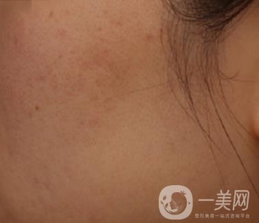 南通維多利亞美容醫(yī)院怎么樣?價(jià)格表收費(fèi)項(xiàng)目和祛痘*果實(shí)拍圖