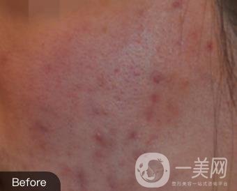 南通維多利亞美容醫(yī)院怎么樣?價(jià)格表收費(fèi)項(xiàng)目和祛痘*果實(shí)拍圖