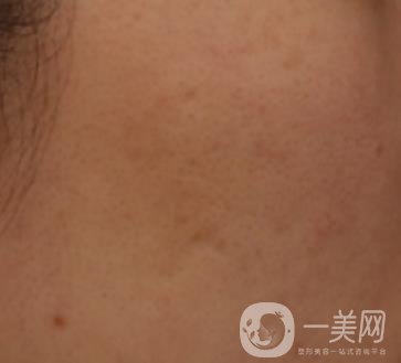 南通維多利亞美容醫(yī)院怎么樣?價(jià)格表收費(fèi)項(xiàng)目和祛痘*果實(shí)拍圖