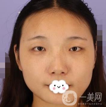 北京安貞醫(yī)院整容怎么樣？李斌斌修復(fù)雙眼皮怎么樣？內(nèi)含案例及價格表