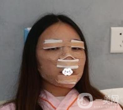 北京安貞醫(yī)院整容怎么樣？李斌斌修復(fù)雙眼皮怎么樣？內(nèi)含案例及價格表