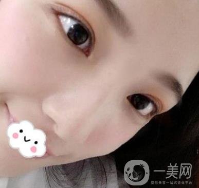 北京安貞醫(yī)院整容怎么樣？李斌斌修復(fù)雙眼皮怎么樣？內(nèi)含案例及價格表