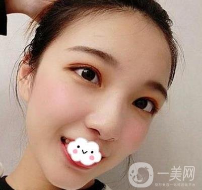 北京安貞醫(yī)院整容怎么樣？李斌斌修復(fù)雙眼皮怎么樣？內(nèi)含案例及價格表