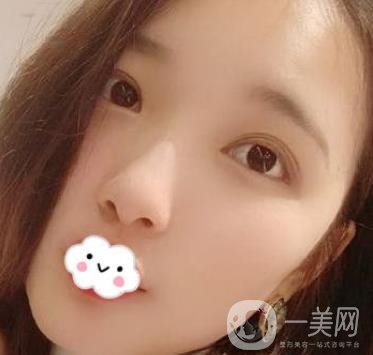 北京安貞醫(yī)院整容怎么樣？李斌斌修復(fù)雙眼皮怎么樣？內(nèi)含案例及價格表