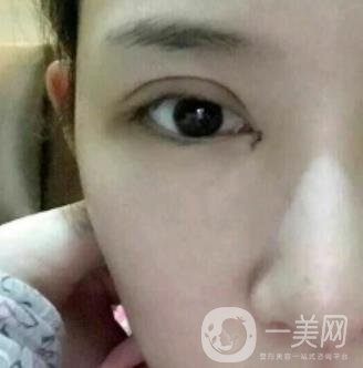 北京克萊美舍張冰潔雙眼皮評價怎么樣？案例及價格表一覽