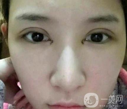 北京克萊美舍張冰潔雙眼皮評價怎么樣？案例及價格表一覽