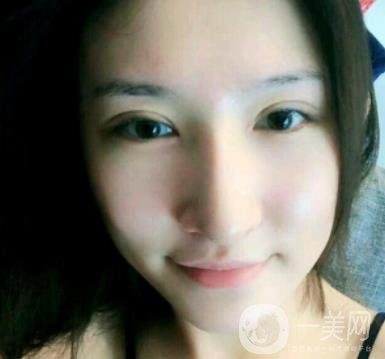 北京克萊美舍張冰潔雙眼皮評價怎么樣？案例及價格表一覽