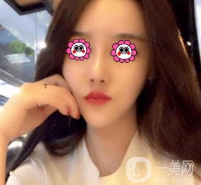 長沙中南大學(xué)*三醫(yī)院整形美容外科隆鼻多少錢？價格表及案例詳情