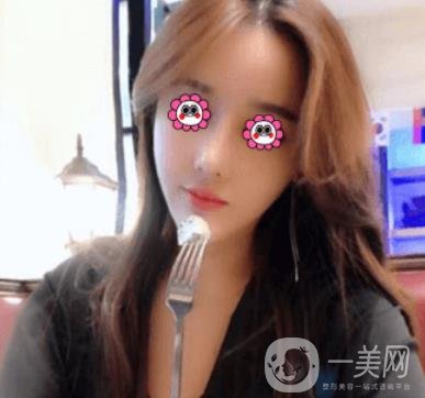 長沙中南大學(xué)*三醫(yī)院整形美容外科隆鼻多少錢？價格表及案例詳情