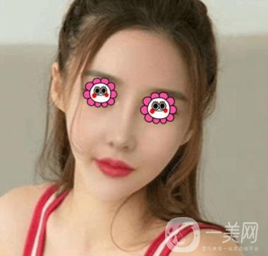 長沙中南大學(xué)*三醫(yī)院整形美容外科隆鼻多少錢？價格表及案例詳情