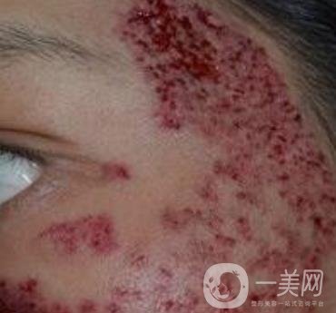 解放軍總醫(yī)院整形美容科*新價(jià)格表發(fā)布,附祛斑案例日記分享