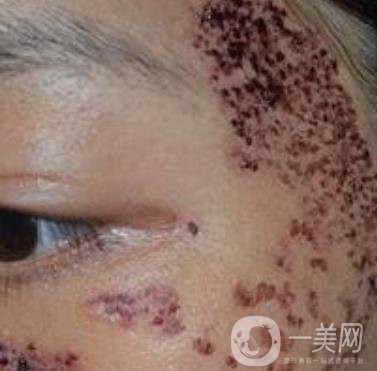 解放軍總醫(yī)院整形美容科*新價(jià)格表發(fā)布,附祛斑案例日記分享