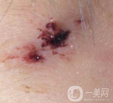 泰安市中心醫(yī)院美容整形科價格表,附祛疤案例*果分享