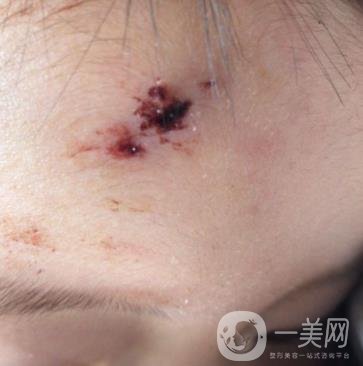 泰安市中心醫(yī)院美容整形科價格表,附祛疤案例*果分享