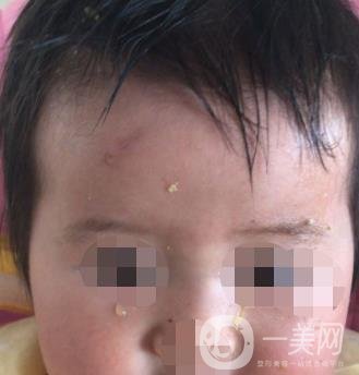 泰安市中心醫(yī)院美容整形科價格表,附祛疤案例*果分享