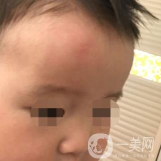 泰安市中心醫(yī)院美容整形科價格表,附祛疤案例*果分享