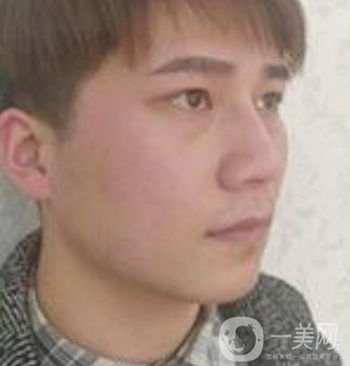 棗莊市立醫(yī)院燒傷整形美容科做光子嫩膚好嗎？價格表及術(shù)后*果分享