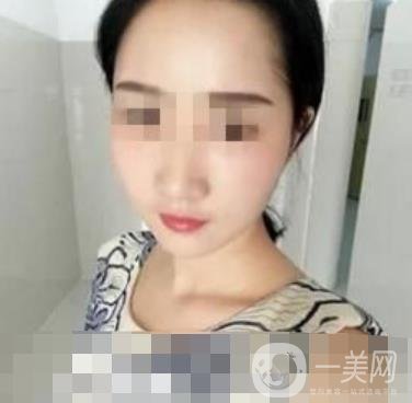 邢臺(tái)市人民醫(yī)院美容科陳譽(yù)華*案例_價(jià)格表明細(xì)