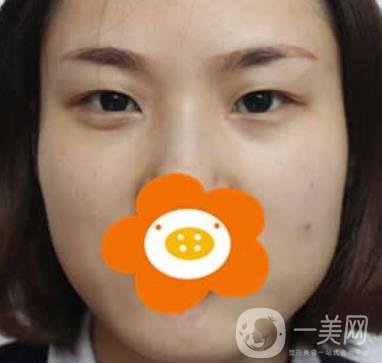 成都*做雙眼皮前后*果圖，附整形美容科價(jià)格收費(fèi)表一覽