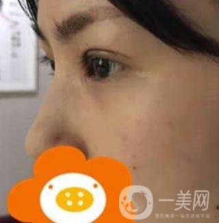 成都*做雙眼皮前后*果圖，附整形美容科價(jià)格收費(fèi)表一覽
