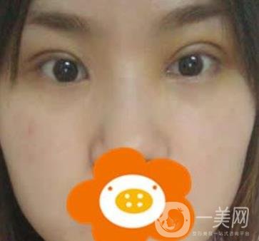 成都*做雙眼皮前后*果圖，附整形美容科價(jià)格收費(fèi)表一覽