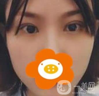 成都*做雙眼皮前后*果圖，附整形美容科價(jià)格收費(fèi)表一覽