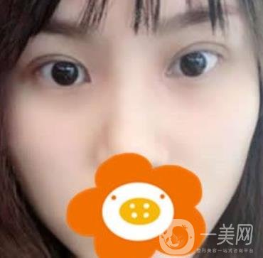 成都*做雙眼皮前后*果圖，附整形美容科價(jià)格收費(fèi)表一覽