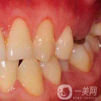 中大光華口腔醫(yī)院種植牙多少錢?價(jià)格表2020年項(xiàng)目明細(xì)一覽