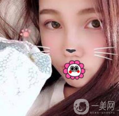 河南省人民醫(yī)院誰做雙眼皮好？附案例及2020整形價(jià)格表