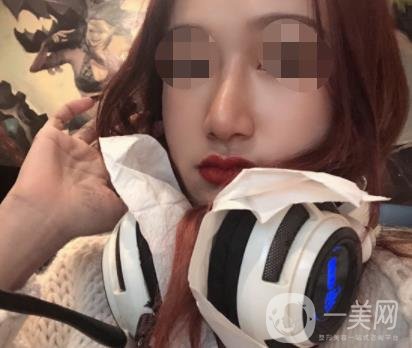 遼寧省人民醫(yī)院美容科怎么樣？附袁繼龍隆鼻案例