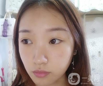 北大醫(yī)院美容價格表，附自體脂肪填充面部前后照