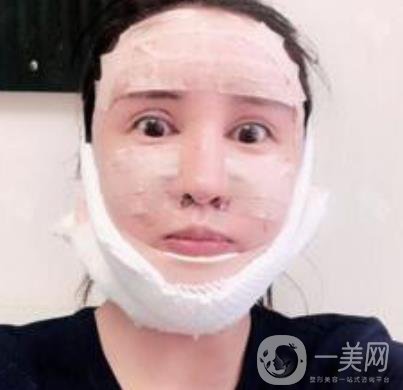 北大醫(yī)院美容價格表，附自體脂肪填充面部前后照