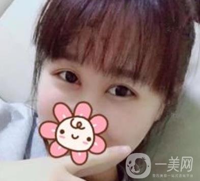 2020浙江省人民醫(yī)院整形價格表，附雙眼皮案例