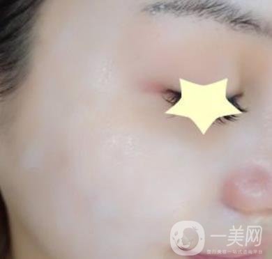 珠海中西醫(yī)結(jié)合醫(yī)院整形價格表及激光祛斑案例一覽