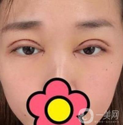 山大二院整形科2020價格表公布,附雙眼皮案例術(shù)后*果圖