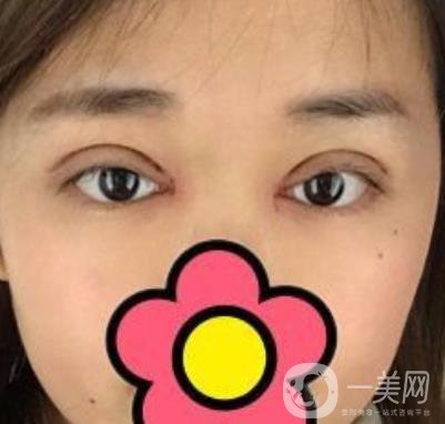 山大二院整形科2020價格表公布,附雙眼皮案例術(shù)后*果圖