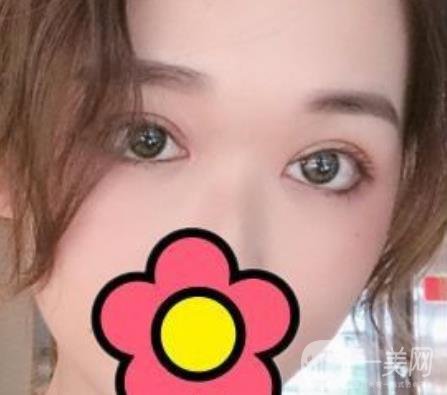 山大二院整形科2020價格表公布,附雙眼皮案例術(shù)后*果圖