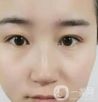 長海醫(yī)院邢新做雙眼皮修復好嗎？價格表及案例詳情一覽