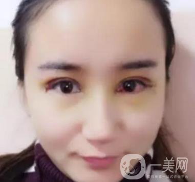 長海醫(yī)院邢新做雙眼皮修復好嗎？價格表及案例詳情一覽
