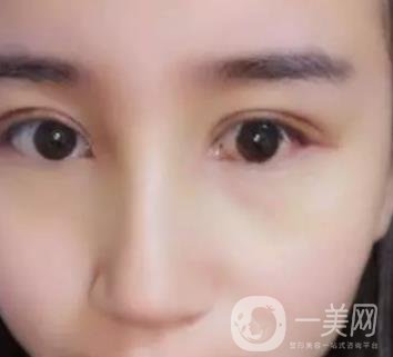 長海醫(yī)院邢新做雙眼皮修復好嗎？價格表及案例詳情一覽